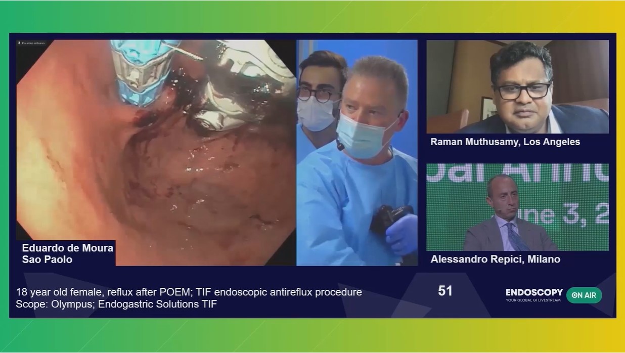 TIF endoscopic antireflux - Endoscopy On Air